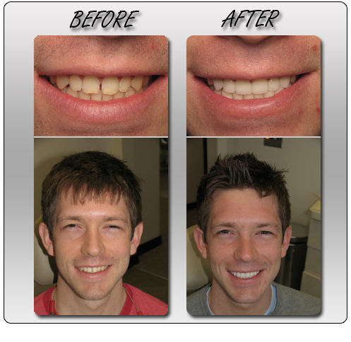 Invisalign Before and After 2